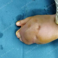 Llawfeddygaeth Gwahanu Dwylo Rhaw